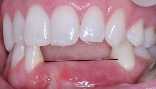 Trồng răng cửa hàm dưới với phương pháp nào? 2