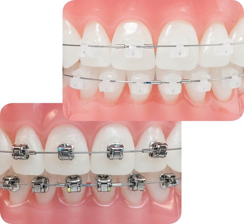 Niềng răng có bị hóp má không? Cách khắc phục ít người biết 2