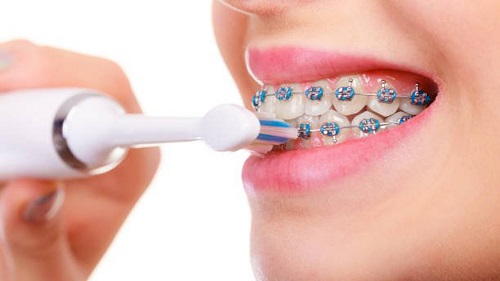 Niềng răng dùng bàn chải gì là tốt nhất? 2