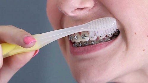 Niềng răng dùng bàn chải gì là tốt nhất? 3