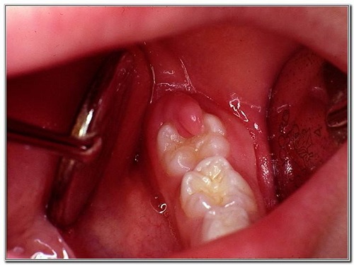 Viêm ổ răng khôn chữa trị như thế nào? 2