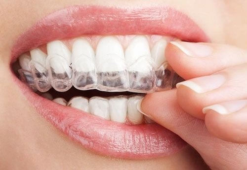 Niềng răng invisalign có nhổ răng không? Tìm hiểu 1