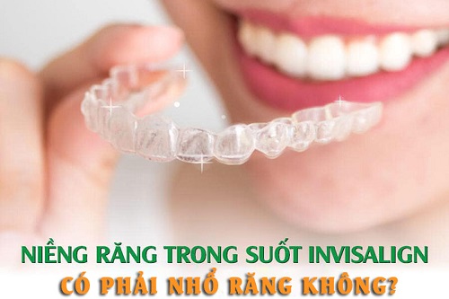 Niềng răng invisalign có nhổ răng không? Tìm hiểu 2