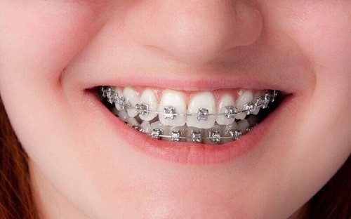 Niềng răng chỉnh hàm lệch lạc - Giải pháp tốt cho bạn 2