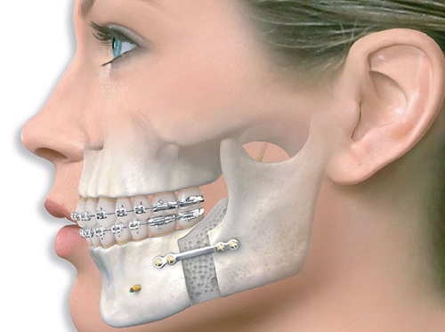 Niềng răng chỉnh hàm lệch lạc - Giải pháp tốt cho bạn 3