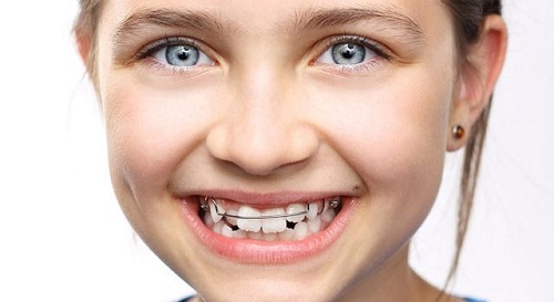 Niềng răng cho trẻ 10 tuổi - Những điều đúng sai 1