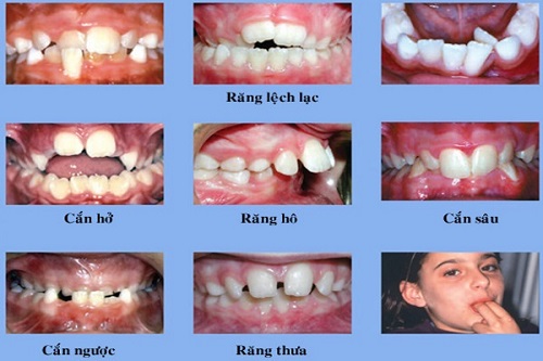 Niềng răng cho trẻ 10 tuổi - Những điều đúng sai 2