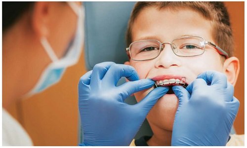 Niềng răng cho trẻ 10 tuổi - Những điều đúng sai 4