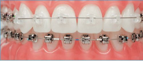 Niềng răng phải đeo hàm duy trì bao lâu? Bác sĩ chuyên khoa tư vấn 1