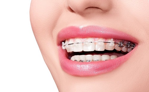 Trồng răng giả có niềng được không? Tham khảo kỹ thuật niềng răng 1