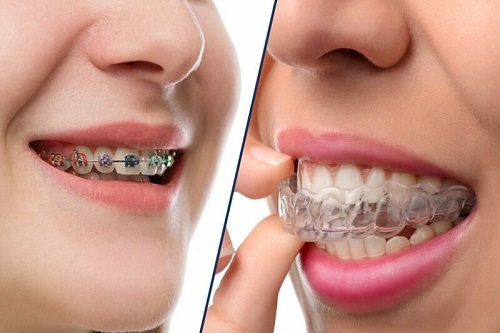 Trồng răng giả có niềng được không? Tham khảo kỹ thuật niềng răng 2