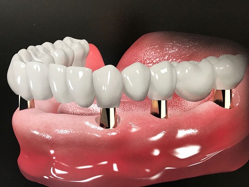 Trồng răng hàm implant giá bao nhiêu? Bảng giá mới nhất 3