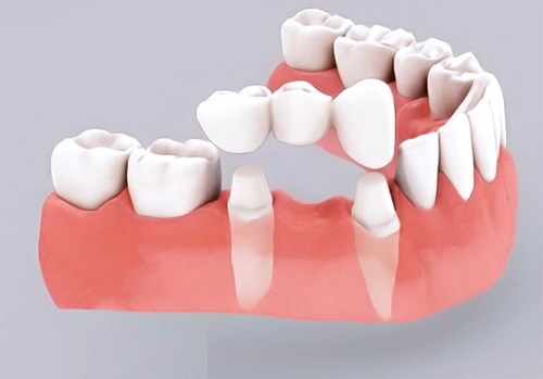 Trồng răng bằng cầu răng - Tìm hiểu về các loại cầu răng 1