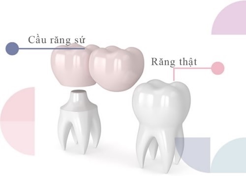 Trồng răng bằng cầu răng - Tìm hiểu về các loại cầu răng 2