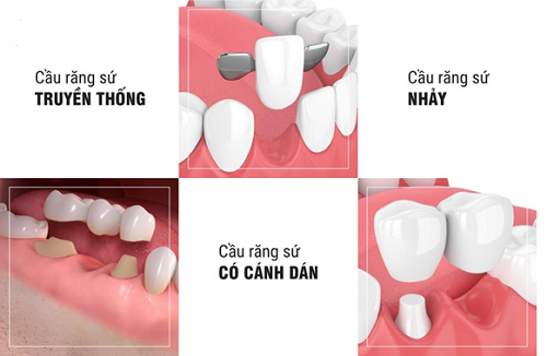 Trồng răng bằng cầu răng - Tìm hiểu về các loại cầu răng 3