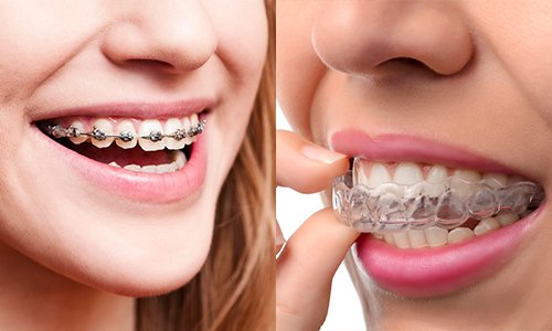 Niềng răng có tốt không? Nên áp dụng với trường hợp nào? 2