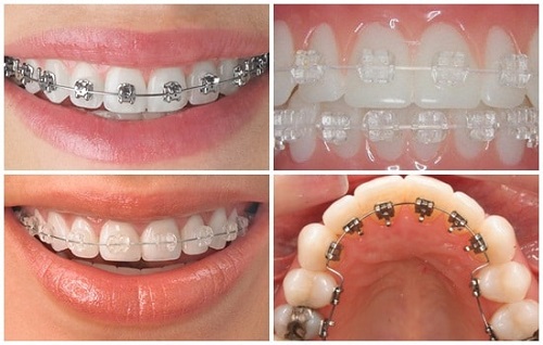 Niềng răng khểnh mất bao lâu là răng đều đặn? 3