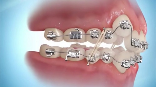 Niềng răng giai đoạn nào đau nhất? Cách xử lý 1