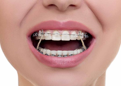 Niềng răng giai đoạn nào đau nhất? Cách xử lý 2