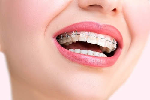 Niềng răng giai đoạn nào đau nhất? Cách xử lý 3