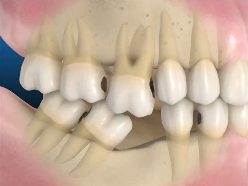 Trồng răng có chân răng - Áp dụng kỹ thuật nào? 1