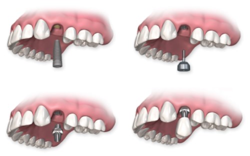 Trồng răng có chân răng - Áp dụng kỹ thuật nào? 3
