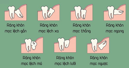 Chụp x quang răng khôn bao nhiêu tiền? Tìm hiểu 3
