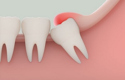 Sưng lợi ở răng khôn - Nhận biết và điều trị dứt điểm 1