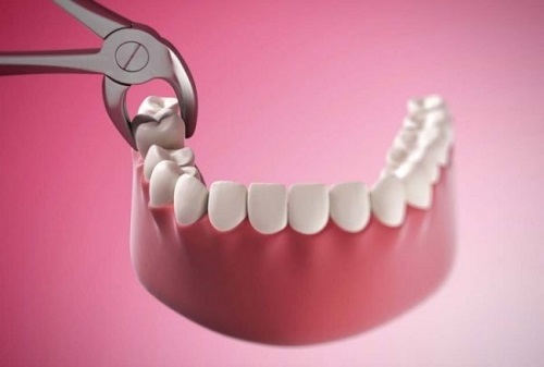 Sưng lợi ở răng khôn - Nhận biết và điều trị dứt điểm 3