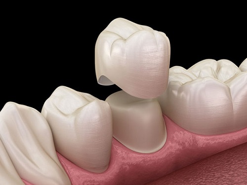 Có nên trồng răng sứ kim loại không? Bác sĩ tư vấn 2