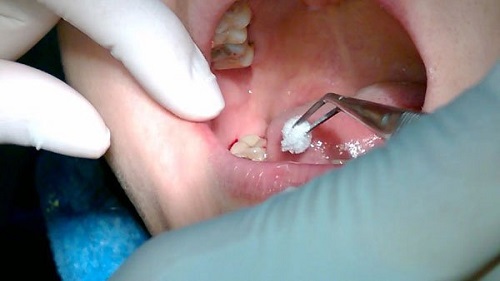 Nhổ 2 răng khôn hàm trên - Tham khảo ý kiến bác sĩ 1