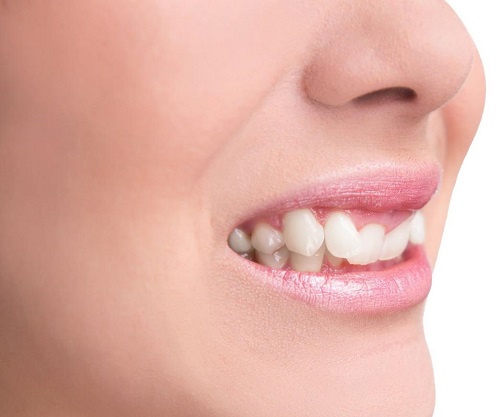 Trồng răng khểnh có đau không? Tham khảo tư vấn 1