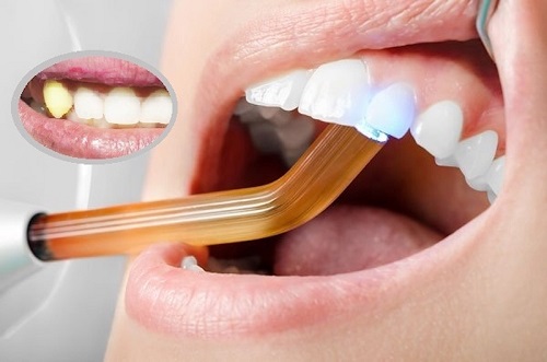Trồng răng khểnh có đau không? Tham khảo tư vấn 2