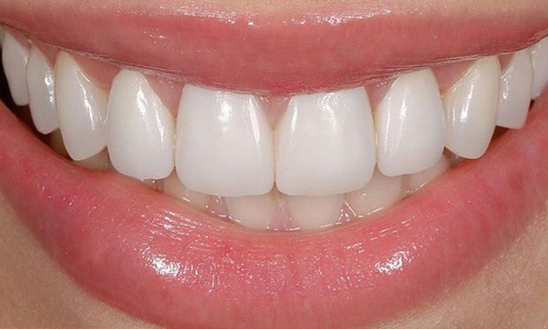 Trồng răng sứ có ảnh hưởng gì không? Những điều bạn cần biết 1