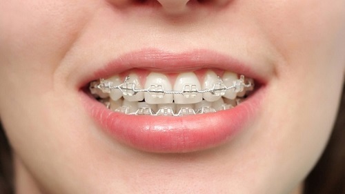 Niềng răng phải nhổ răng nào giúp đạt kết quả cao? 1