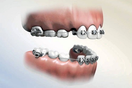 Niềng răng phải nhổ răng nào giúp đạt kết quả cao? 3