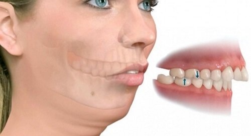Niềng răng khớp cắn sâu - Phục hình thẩm mỹ nha khoa 1