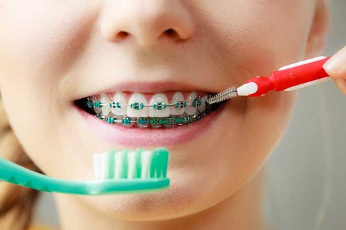 Niềng răng có nên dùng bàn chải điện để vệ sinh? 2
