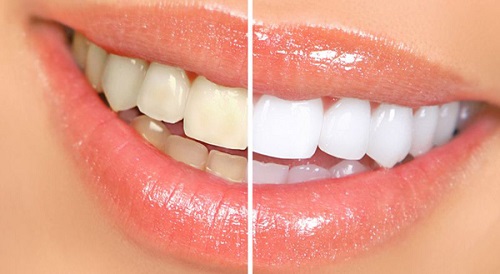 Niềng răng xong có nên tẩy trắng răng không? 1