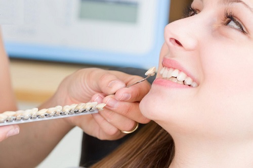 Trồng răng khểnh ở đâu? Thông tin cần biết trước khi trồng răng 2