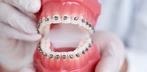 Niềng răng bị viêm lợi có tháo niềng không? 1
