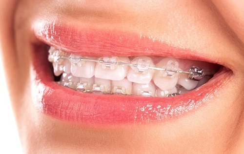 Niềng răng bị viêm lợi có tháo niềng không? 2 Niềng răng bị viêm lợi có tháo niềng không? 2