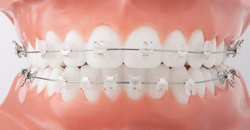 Niềng răng bị viêm lợi có tháo niềng không? 3 Niềng răng bị viêm lợi có tháo niềng không? 3