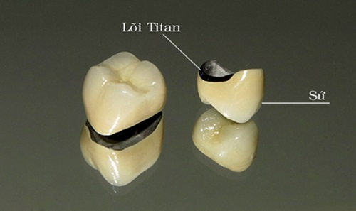 Trồng răng sứ bị đen chân răng phải xử lý ra sao? 1