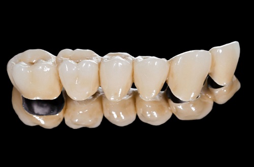 Có nên trồng răng sứ titan để phục hình không? 3