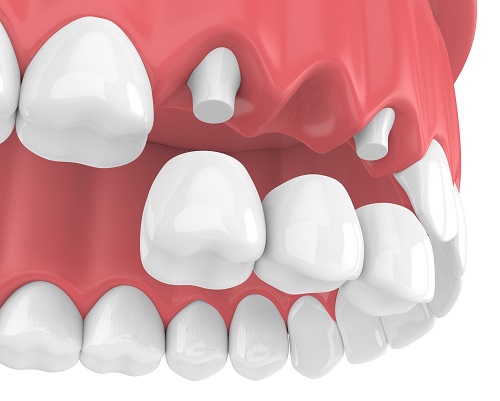 Trồng răng sứ không mài răng có hiệu quả không? 1
