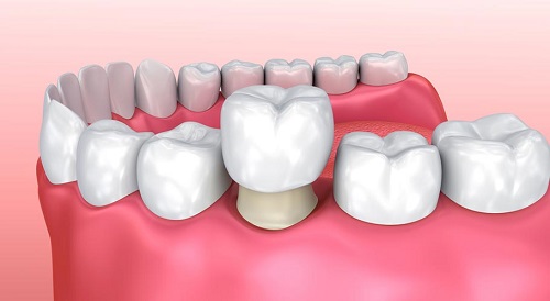 Trồng răng sứ không mài răng có hiệu quả không? 3