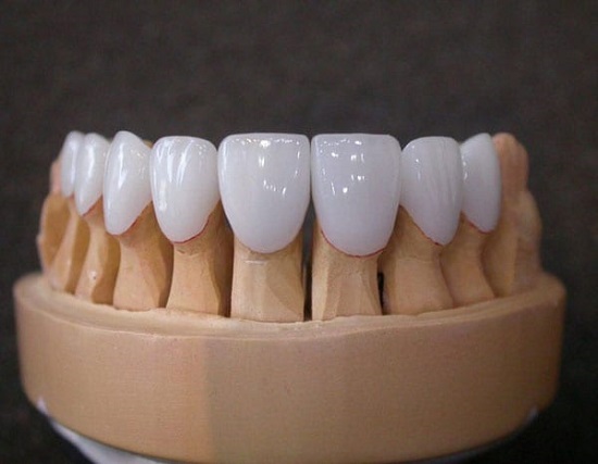 Trồng răng sứ có tốt không? Những điều cần biết 1