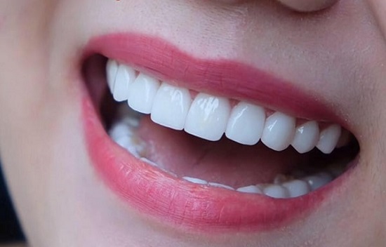 Trồng răng sứ có tốt không? Những điều cần biết 2